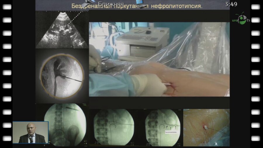 Арустамов Л.Д. - "Бездренажная перкутанная нефролитотрипсия в лечении нефролитиаза у детей." 