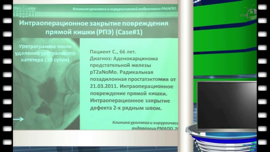 Богданов А.Б. - "Диагностика и лечение уретро - прямокишечных свищей"