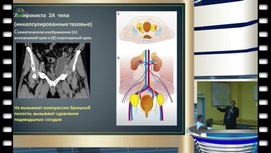  В.Л. Медведев - Поздние осложнения лапароскопической радикальной простатэктомии