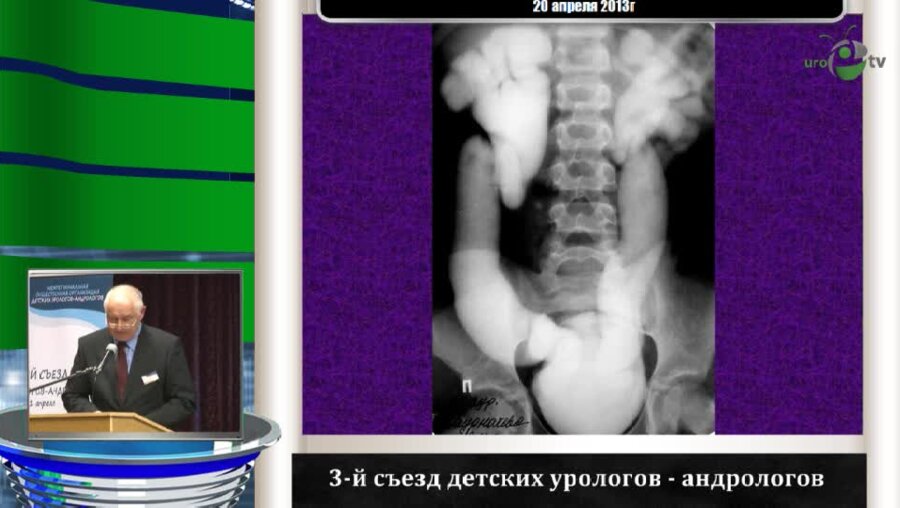 Чумаков П.И. "Антирефлюксная защита почки при обструкции мочеточника"