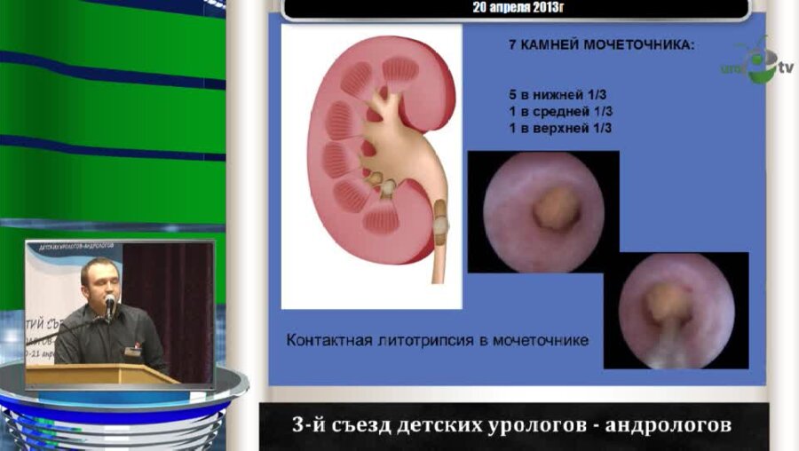 Суров Р.В. "Первый опыт эндоскопического лечения мочекаменной болезни у детей"